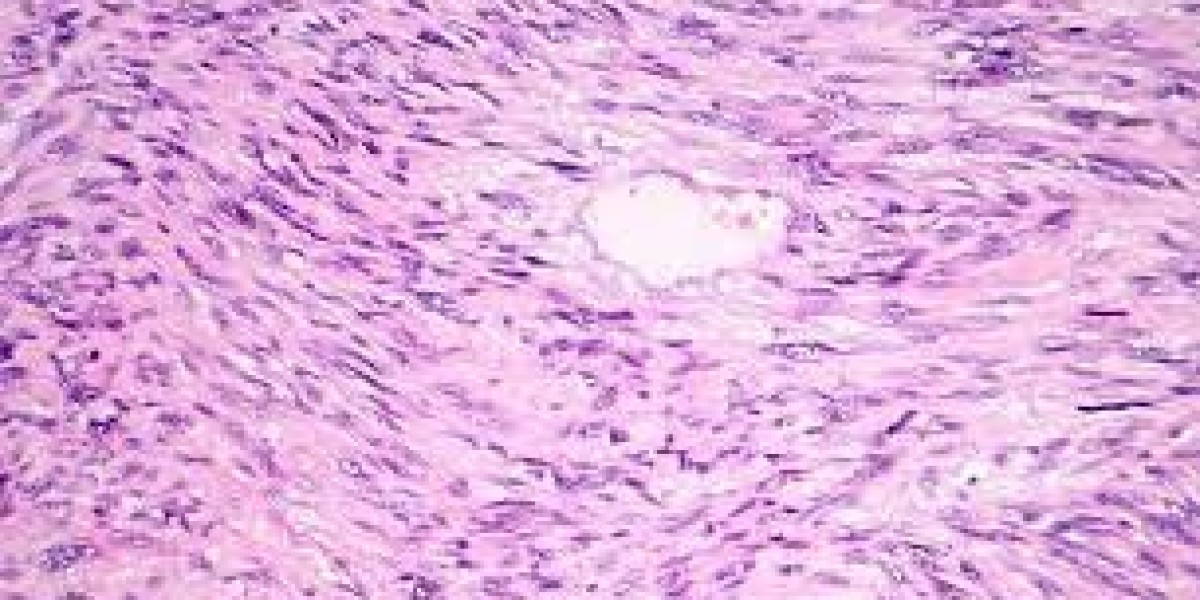 Leiomyosarcoma Market Size, 2023 Analysis, Industry Trends and Forecasts to 2033