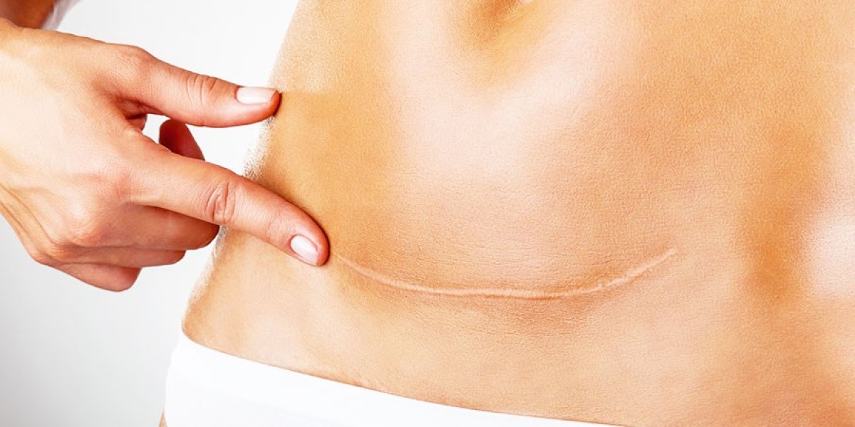 Scar Removal Treatment in Delhi